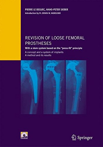 revision of loose femoral prostheses: with a stem system based on the "press-fit" principle